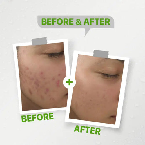 Veta Play Anti-Acne Cream 40g