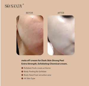 So Sandy Mela of Cold Peel Cream with Whitening Effect 5g